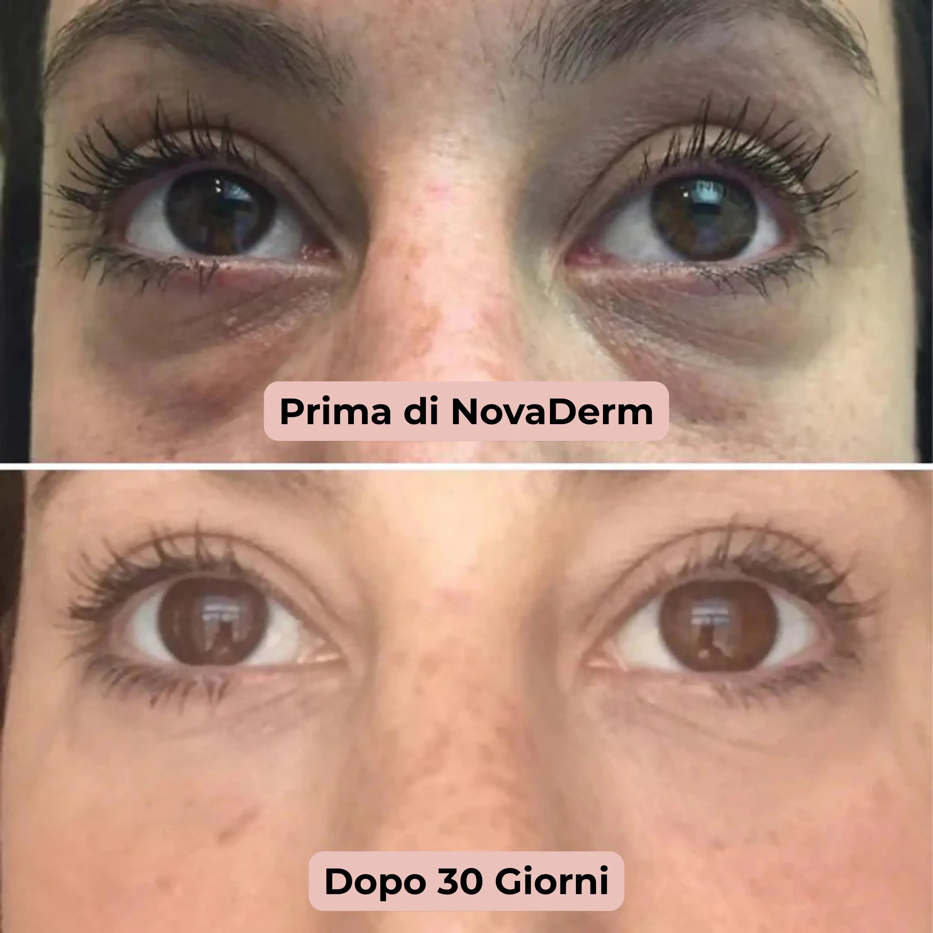 Trattamento per la Riduzione di Occhiaie, Borse e Rughe con Infusione ai Microneedle